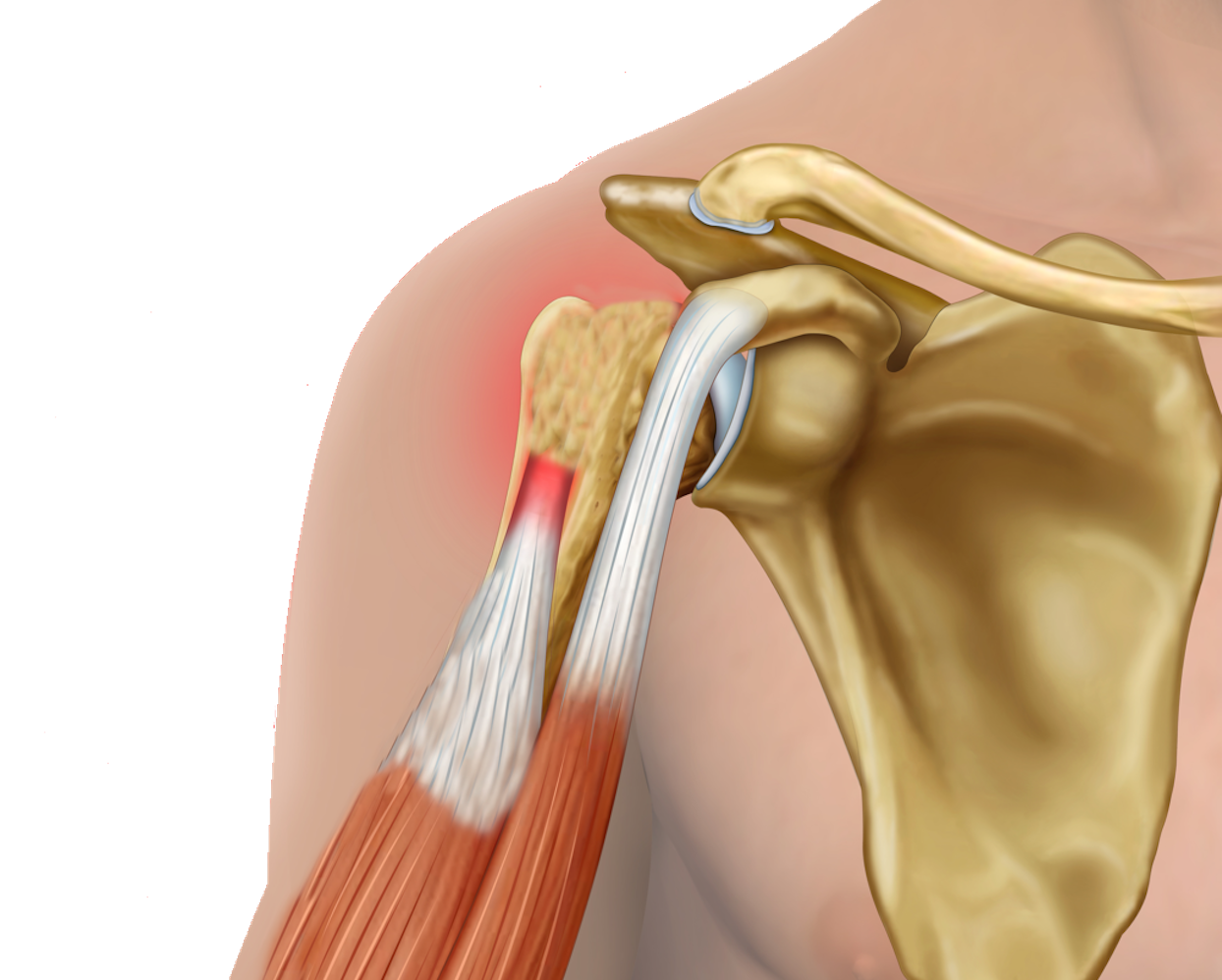 Biceps (LHB) tendon rupture